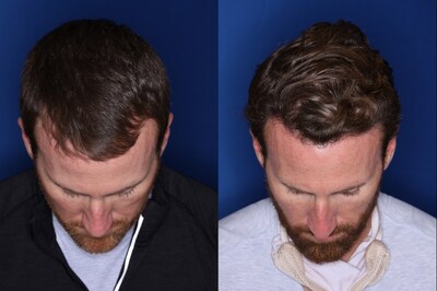 Kalos Hair Transplant