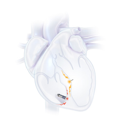WiSE Electrode with leadless right ventricular pacing device