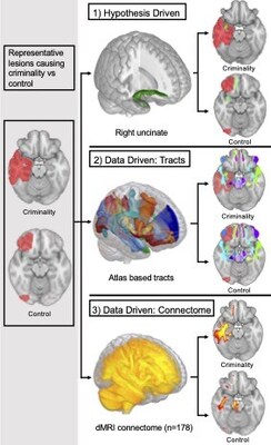 Researchers applied multiple techniques to determine the brain connections associated with new onset criminal behavior. -image from Isaiah Kletenik, MD / Brigham and Women’s Hospital