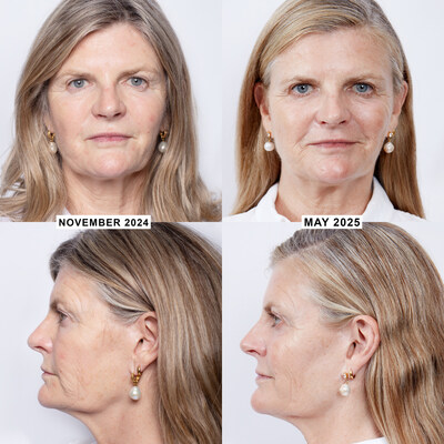 Before and After images of Susannah Constantine following a course of the new Alma Harmony Bio-Boost™ - a non invasive, no downtime bio-stimulating laser treatment (PRNewsfoto/Alma)