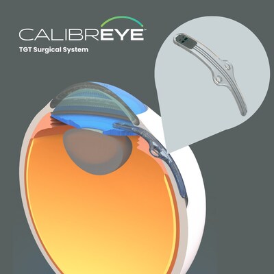Myra Vision's Calibreye Titratable Glaucoma Therapy™ (TGT) Surgical System aims to optimize intraocular pressure (IOP) reduction for patients with moderate to severe glaucoma.