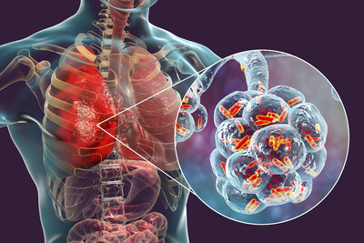 Legionnaires’ disease is a serious lung infection caused by inhaling water droplets contaminated with Legionella bacteria. Outbreaks are often traced to building water systems that have not been properly maintained, such as cooling towers, which can expose entire communities to serious health risks.