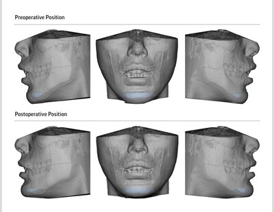 Virtual Surgical Planning (VSP) for corrective jaw and chin surgeries (genioplasty)