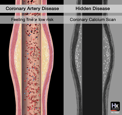 A coronary CT scan can highlight calcification and hidden risk that otherwise may go undetected.
