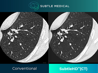 Comparison of lung CT scans showing conventional imaging on the left and SubtleHD(CT)-enhanced imaging on the right.