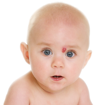 Baby with an infantile hemangioma (IH)