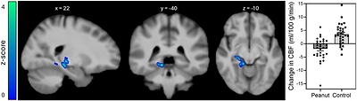 Insulin-induced changes in regional cerebral blood flow (CBF; mL/100 g/min). Whole-brain analysis revealed one cluster in the right hemisphere where CBF responses to intranasal insulin were beneficially affected after the peanut intervention compared with the control period (-5.4 ± 5.4 mL/100 g tissue/min). This cluster encompassed parts of the lingual gyrus, hippocampus, parahippocampal gyrus, thalamus, and posterior cingulate gyrus. The color map corresponds to Z-values.