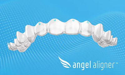 Angelalign Has Already Replaced Torque Ridges with Upgraded “Pressure Points” in Europe